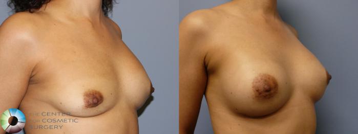 Before & After Breast Implant Revision Case 11373 Right Oblique View in Golden, CO