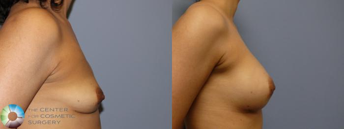 Before & After Breast Implant Revision Case 11373 Right Side View in Golden, CO