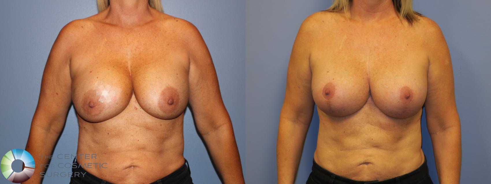 Before & After Breast Lift Case 11406 Front in Denver and Colorado Springs, CO