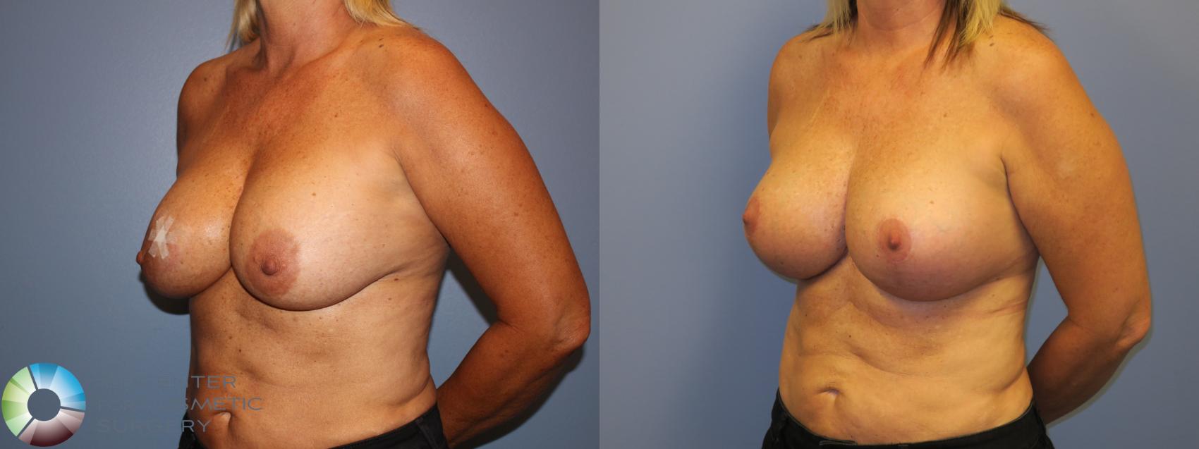 Before & After Breast Implant Revision Case 11406 Left Oblique in Denver and Colorado Springs, CO