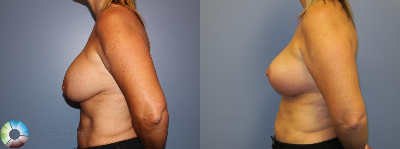 Before & After Breast Implant Revision Case 11406 Left Side in Denver and Colorado Springs, CO