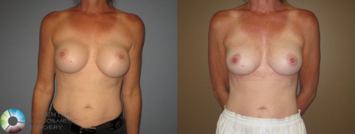 Before & After Breast Implant Revision Case 11407 Front View in Golden, CO