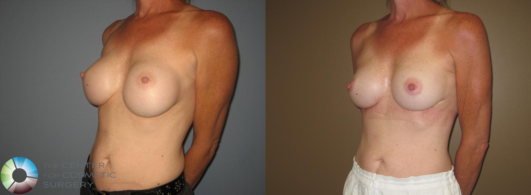 Before & After Breast Implant Revision Case 11407 Left Oblique in Denver and Colorado Springs, CO
