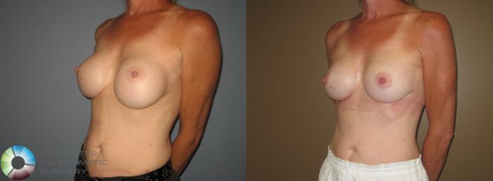 Before & After Breast Implant Revision Case 11407 Left Oblique View in Golden, CO