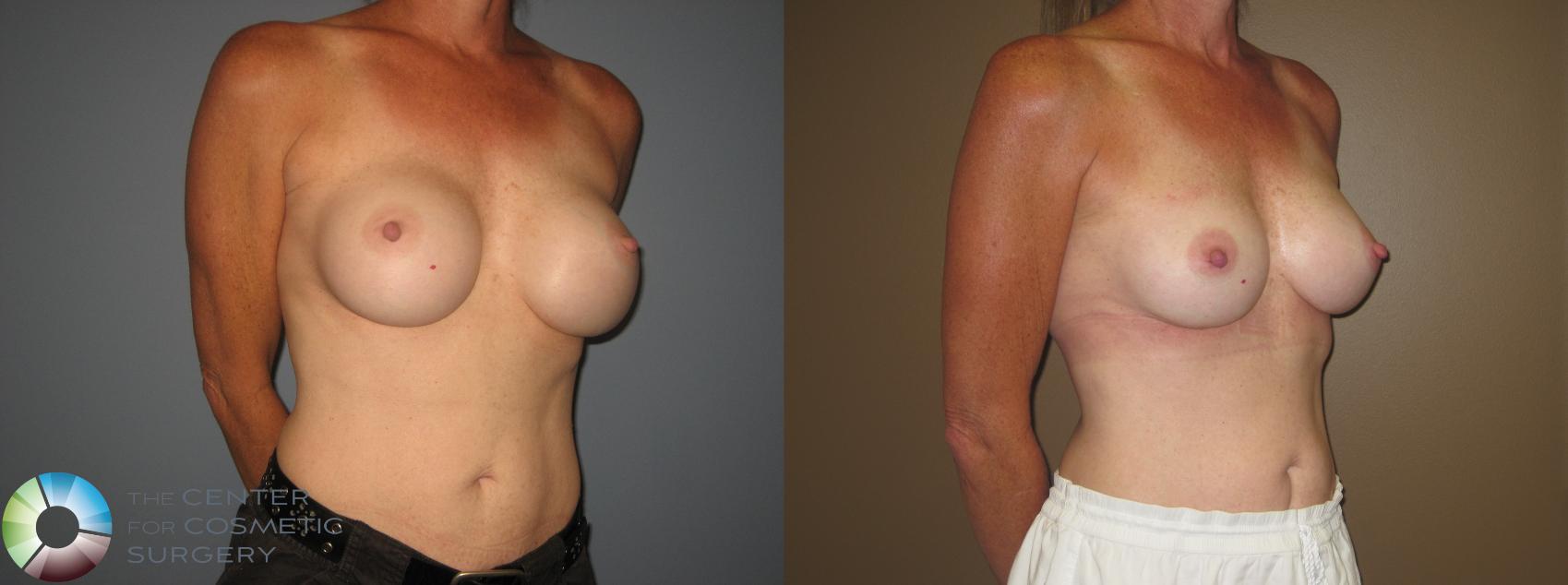 Before & After Breast Implant Revision Case 11407 Right Oblique in Denver and Colorado Springs, CO