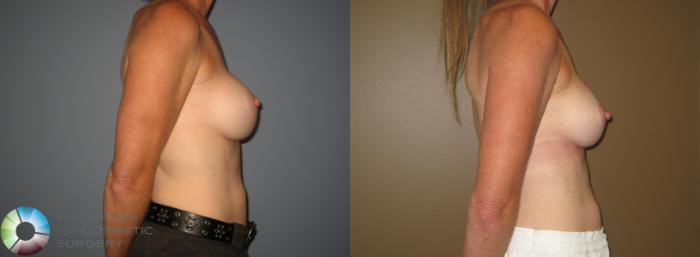 Before & After Breast Implant Revision Case 11407 Right Side View in Golden, CO