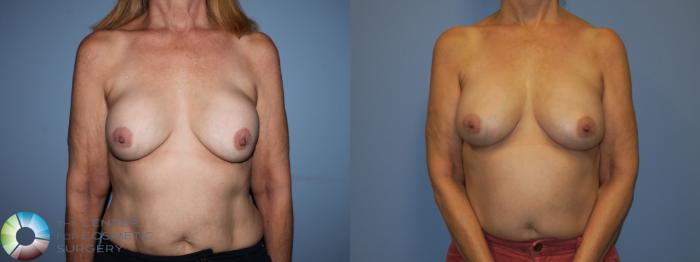 Before & After Breast Implant Revision Case 11408 Front View in Golden, CO
