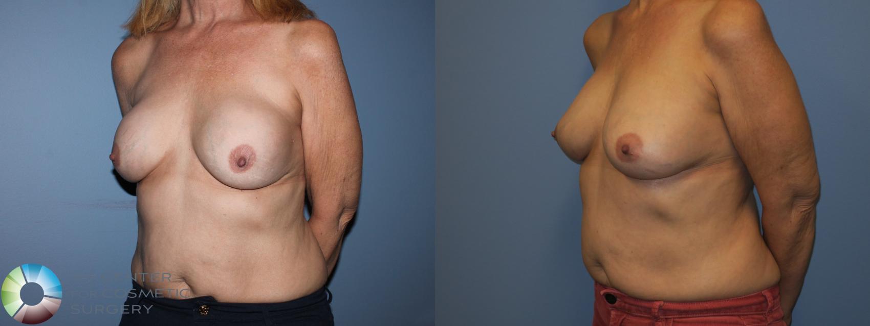 Before & After Breast Implant Revision Case 11408 Left Oblique View in Golden, CO