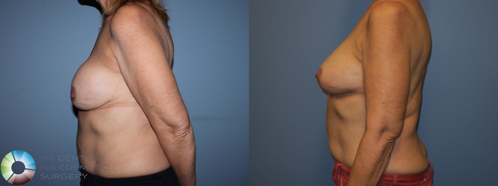 Before & After Breast Implant Revision Case 11408 Left Side View in Golden, CO