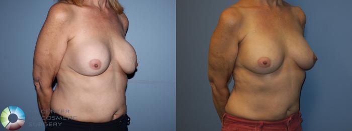 Before & After Breast Implant Revision Case 11408 Right Oblique View in Golden, CO