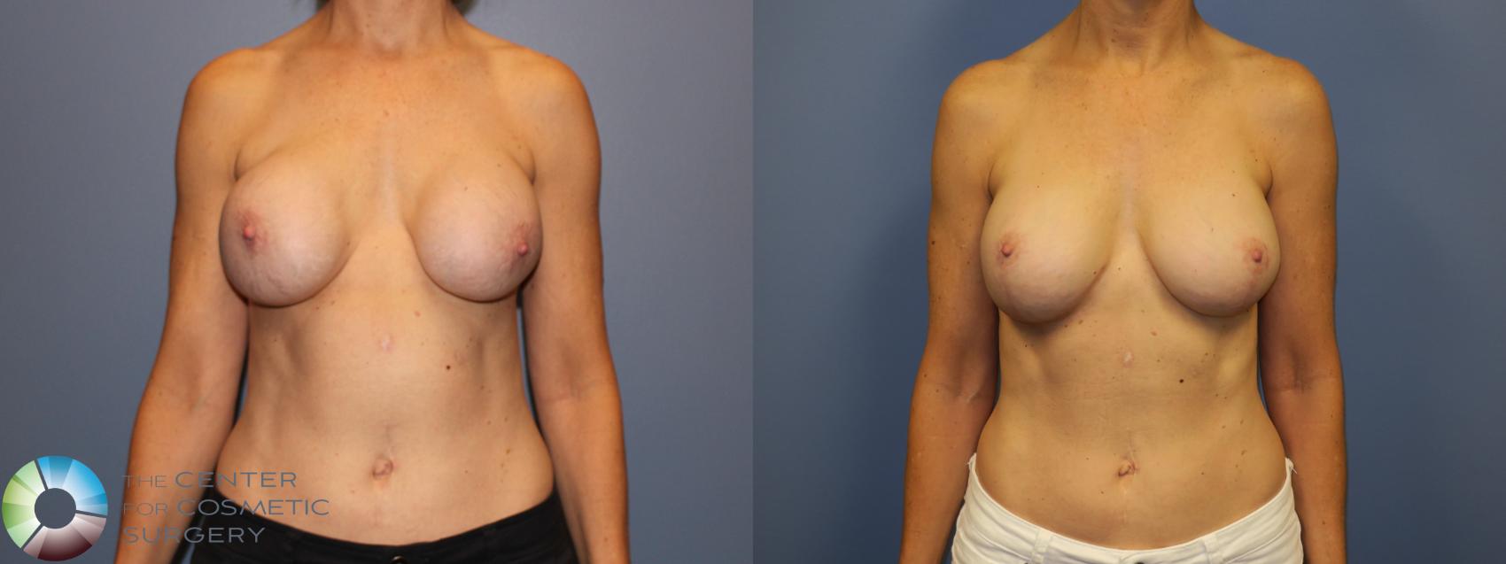 Before & After Breast Implant Revision Case 11409 Front in Denver and Colorado Springs, CO