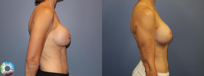 Before & After Breast Implant Revision Case 11409 Right Side View in Golden, CO