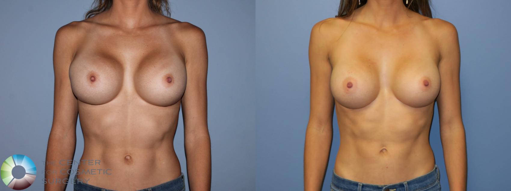 Before & After Breast Implant Revision Case 11410 Front in Denver and Colorado Springs, CO