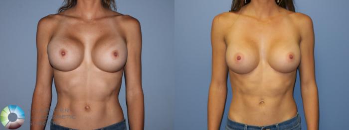 Before & After Breast Implant Revision Case 11410 Front View in Golden, CO