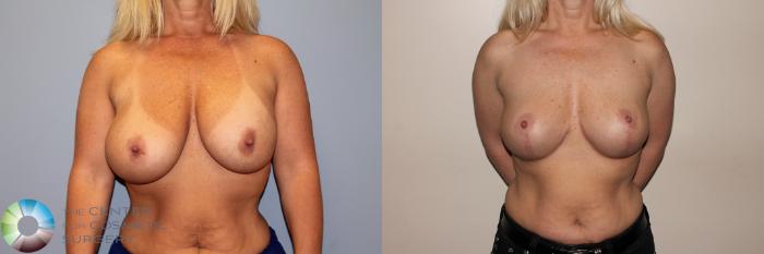 Before & After Breast Implant Revision Case 11411 Front View in Golden, CO