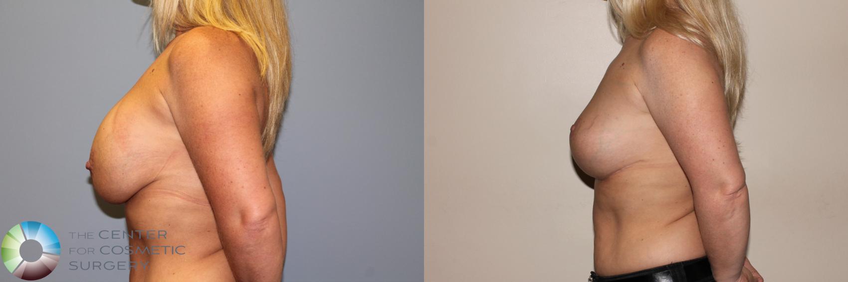 Before & After Breast Implant Revision Case 11411 Left Side in Denver and Colorado Springs, CO