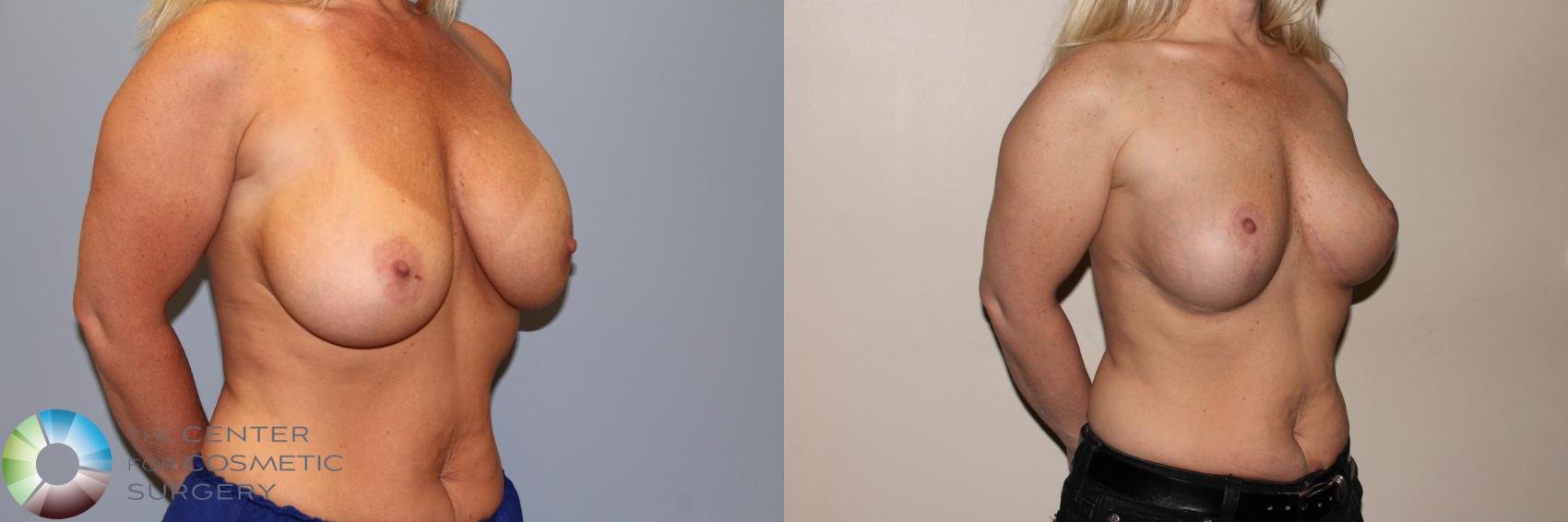 Before & After Breast Implant Revision Case 11411 Right Oblique in Denver and Colorado Springs, CO