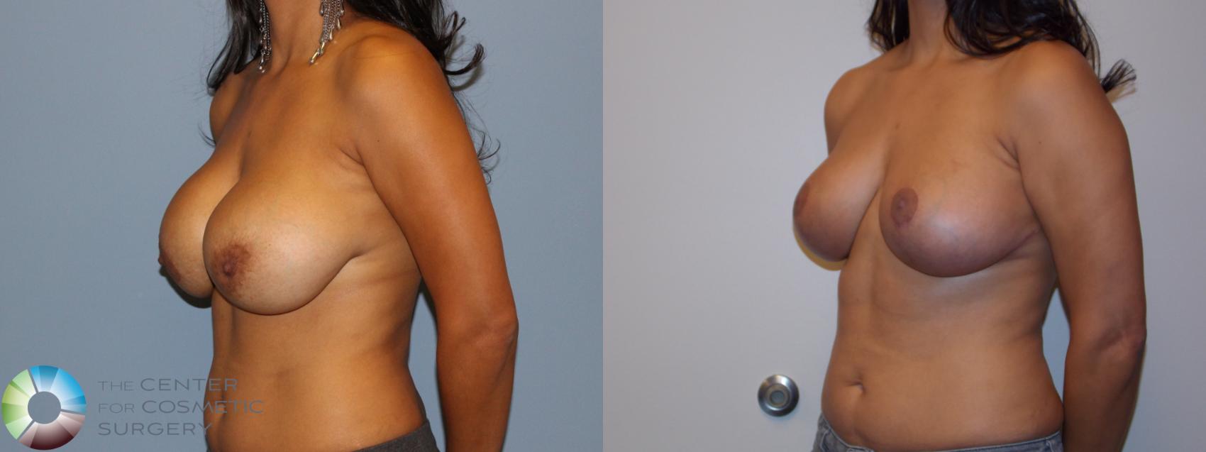 Before & After Breast Implant Revision Case 11437 Left Oblique in Denver and Colorado Springs, CO