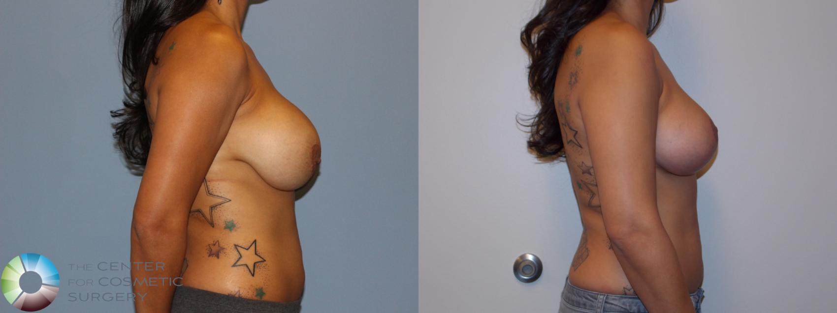Before & After Breast Implant Revision Case 11437 Right Side in Denver and Colorado Springs, CO