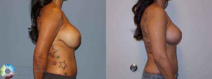 Before & After Breast Implant Revision Case 11437 Right Side View in Golden, CO