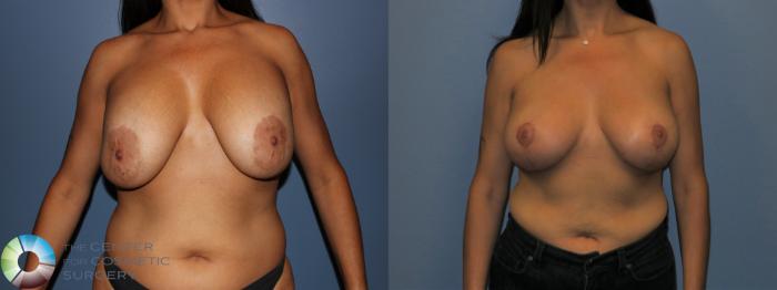 Before & After Breast Implant Revision Case 11438 Front View in Golden, CO