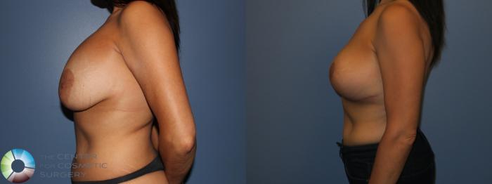 Before & After Breast Implant Revision Case 11438 Left Side View in Golden, CO