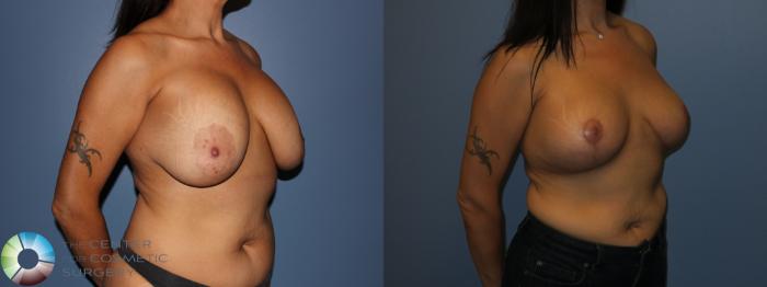 Before & After Breast Implant Revision Case 11438 Right Oblique View in Golden, CO