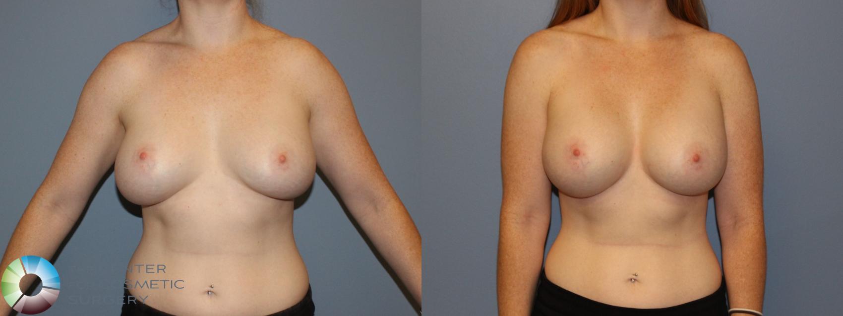 Before & After Breast Implant Revision Case 11441 Front View in Golden, CO