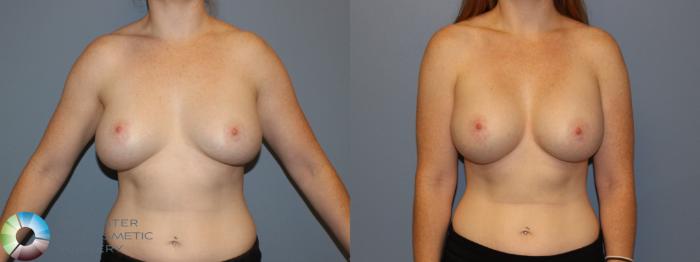 Before & After Breast Implant Revision Case 11441 Front in Denver and Colorado Springs, CO