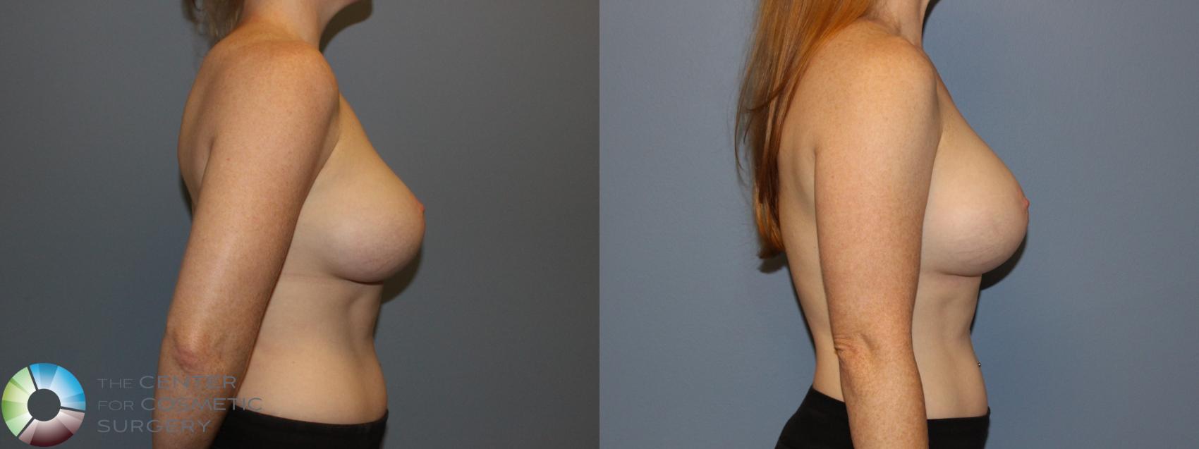 Before & After Breast Implant Revision Case 11441 Right Side View in Golden, CO