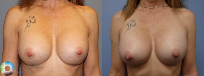 Before & After Breast Implant Revision Case 11443 Front in Denver, CO