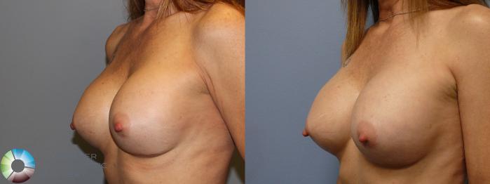 Before & After Breast Implant Revision Case 11443 Left Oblique in Denver, CO