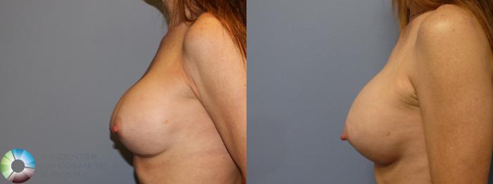 Before & After Breast Implant Revision Case 11443 Left Side in Denver, CO