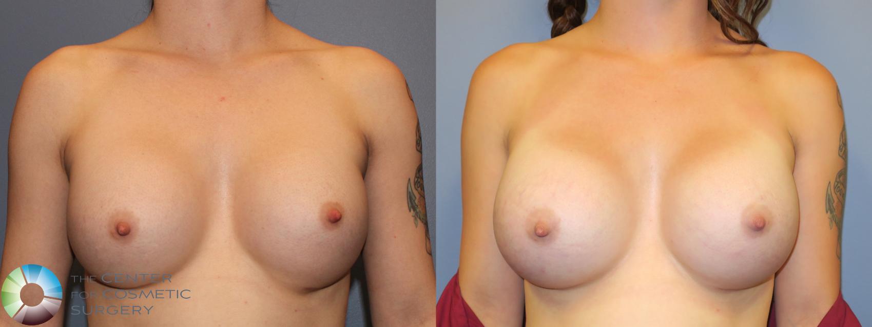 Before & After Breast Implant Revision Case 11444 Front View in Golden, CO