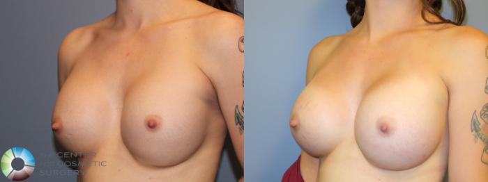 Before & After Breast Implant Revision Case 11444 Left Oblique View in Golden, CO