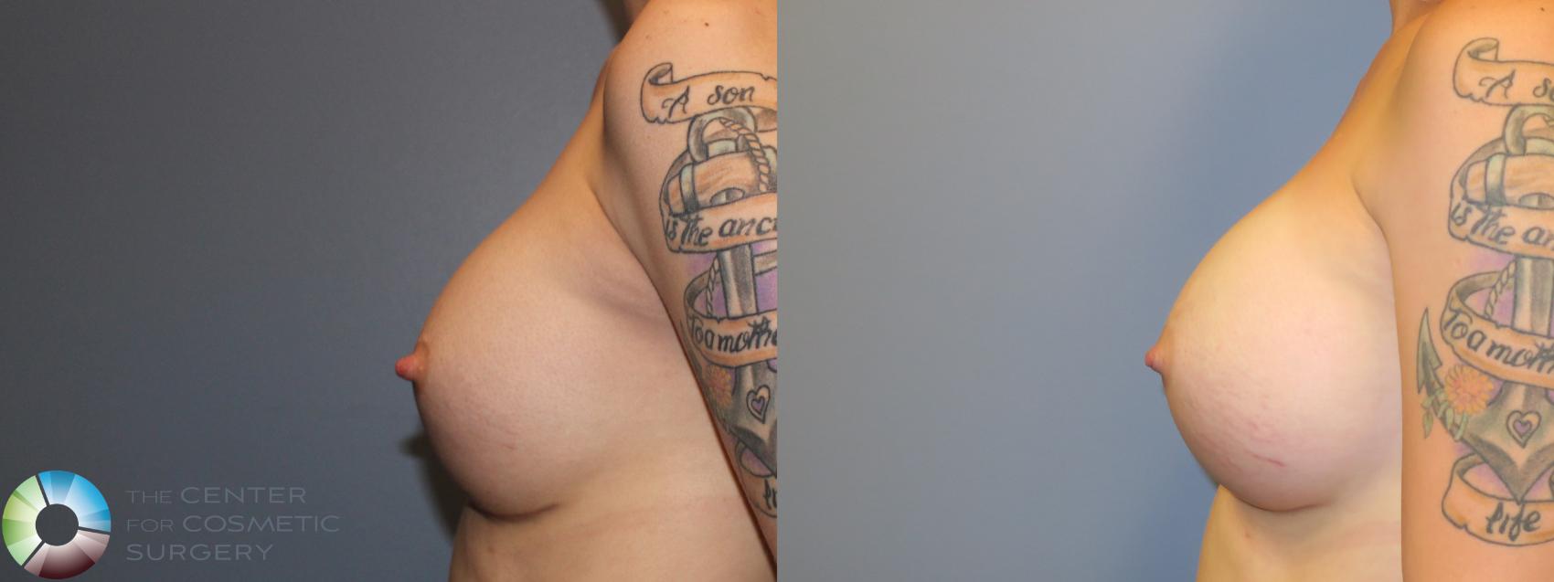 Best Denver Breast Implant Exchange Revision