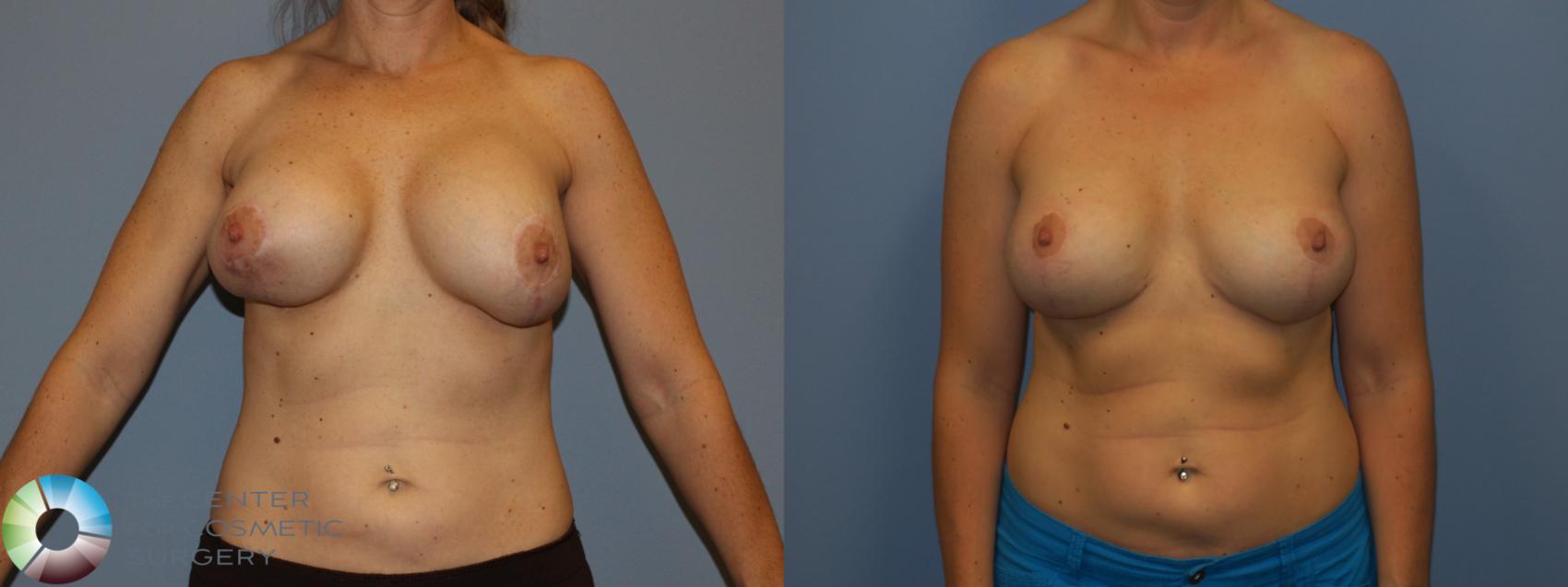 Before & After Breast Implant Revision Case 11445 Front in Denver and Colorado Springs, CO