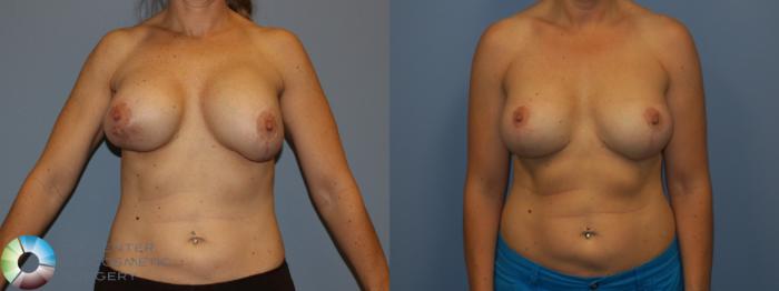 Before & After Breast Implant Revision Case 11445 Front View in Golden, CO