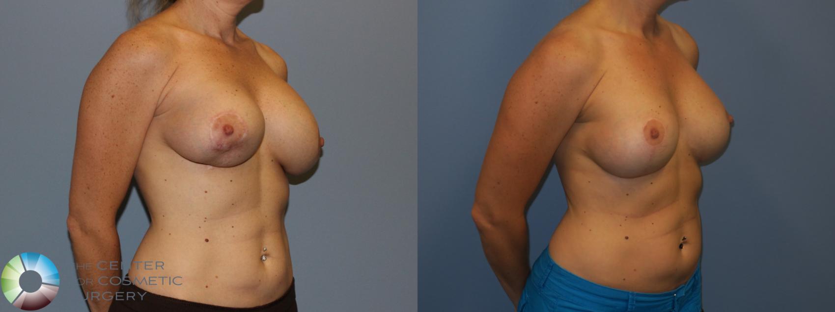 Before & After Breast Implant Revision Case 11445 Right Oblique View in Denver & Golden, CO