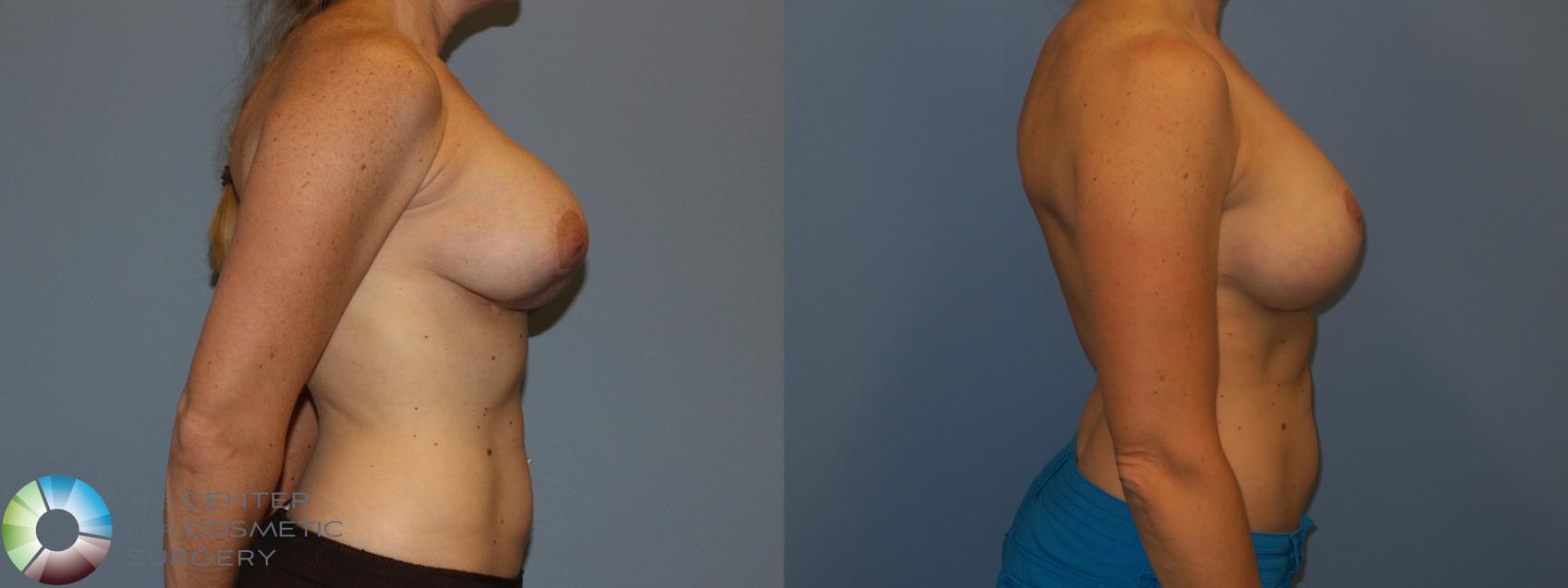 Before & After Breast Implant Revision Case 11445 Right Side View in Golden, CO