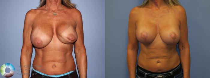 Before & After Breast Implant Revision Case 11446 Front in Denver, CO