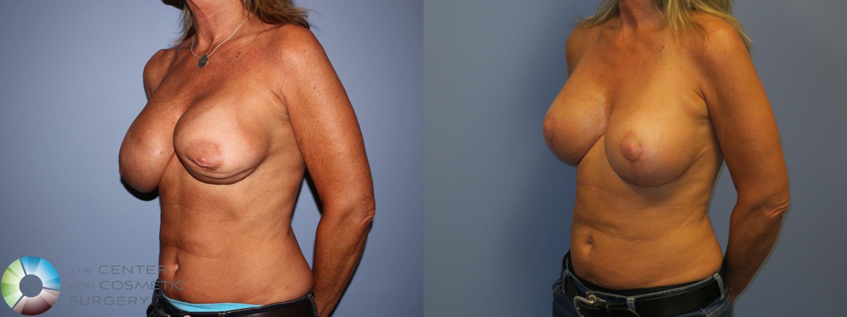 Before & After Breast Implant Revision Case 11446 Left Oblique in Denver and Colorado Springs, CO