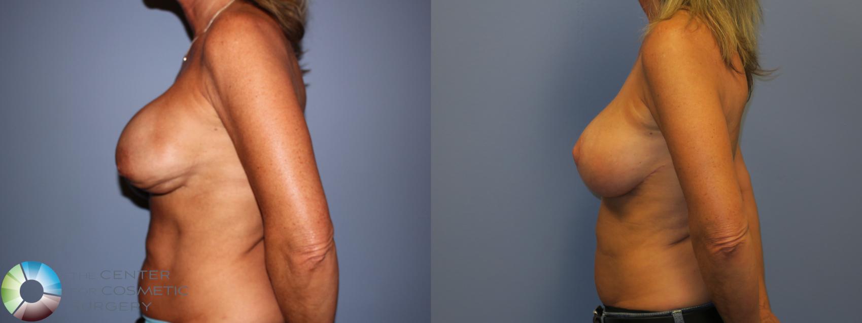 Before & After Breast Implant Revision Case 11446 Left Side in Denver and Colorado Springs, CO