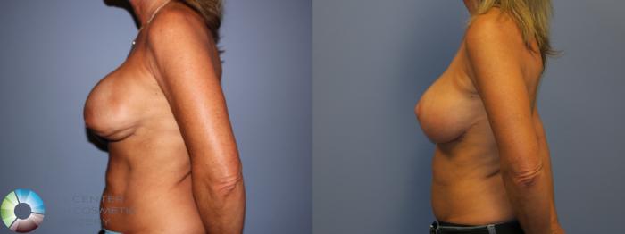 Before & After Breast Implant Revision Case 11446 Left Side in Denver, CO