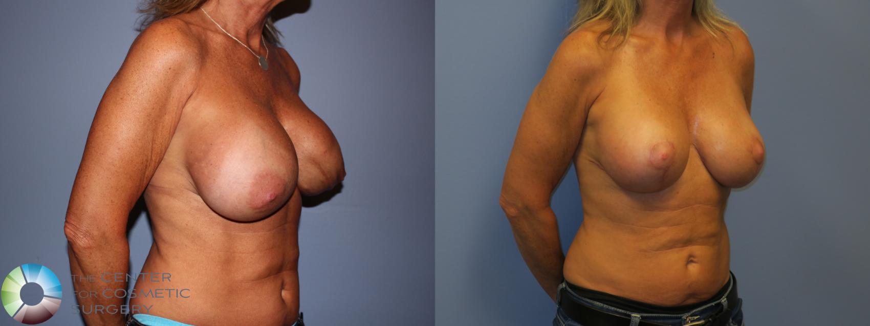 Before & After Breast Implant Revision Case 11446 Right Oblique in Denver and Colorado Springs, CO