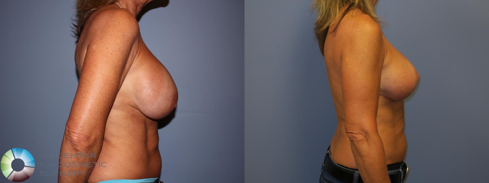 Before & After Breast Implant Revision Case 11446 Right Side in Denver and Colorado Springs, CO
