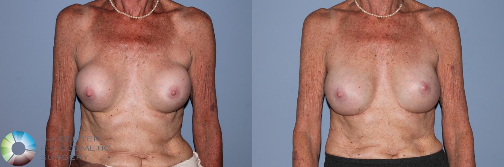 Before & After Breast Implant Revision Case 11478 Front View in Golden, CO