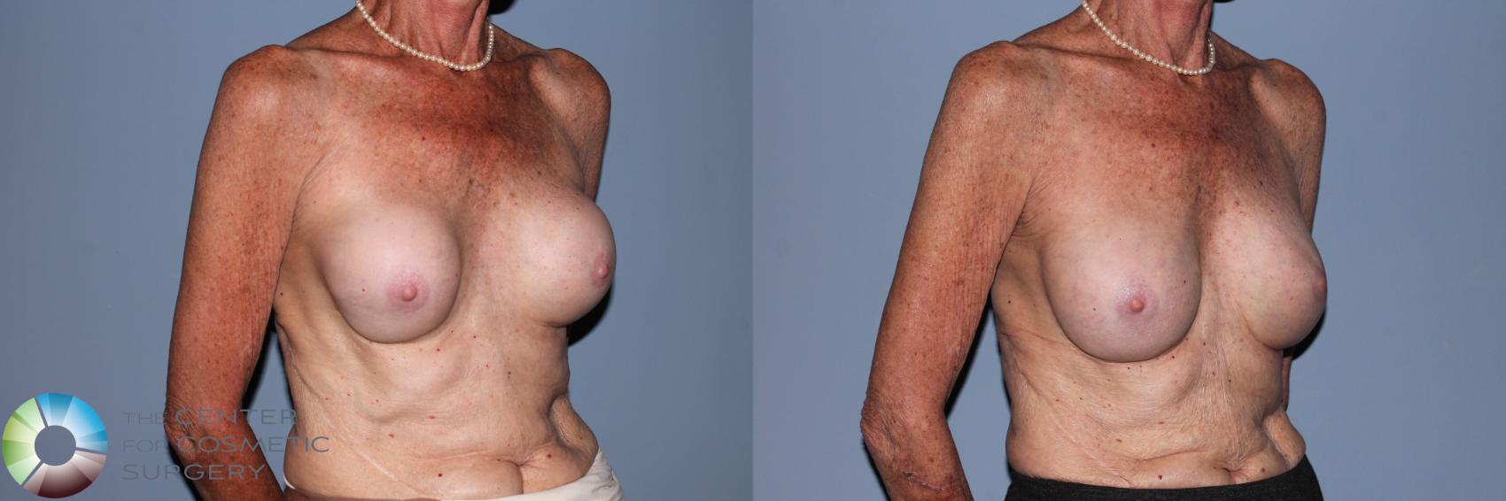 Before & After Breast Implant Revision Case 11478 Right Oblique View in Golden, CO