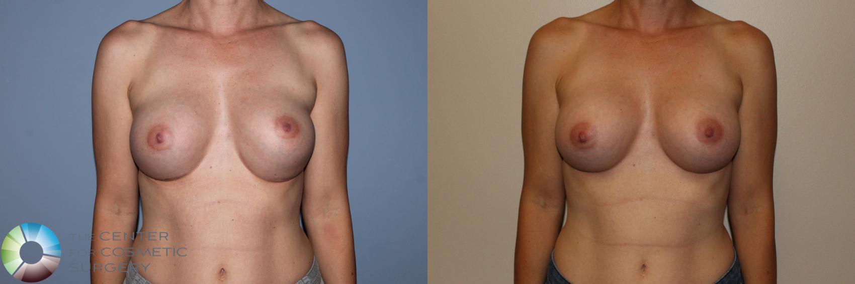 Before & After Breast Implant Revision Case 11501 Front View in Golden, CO