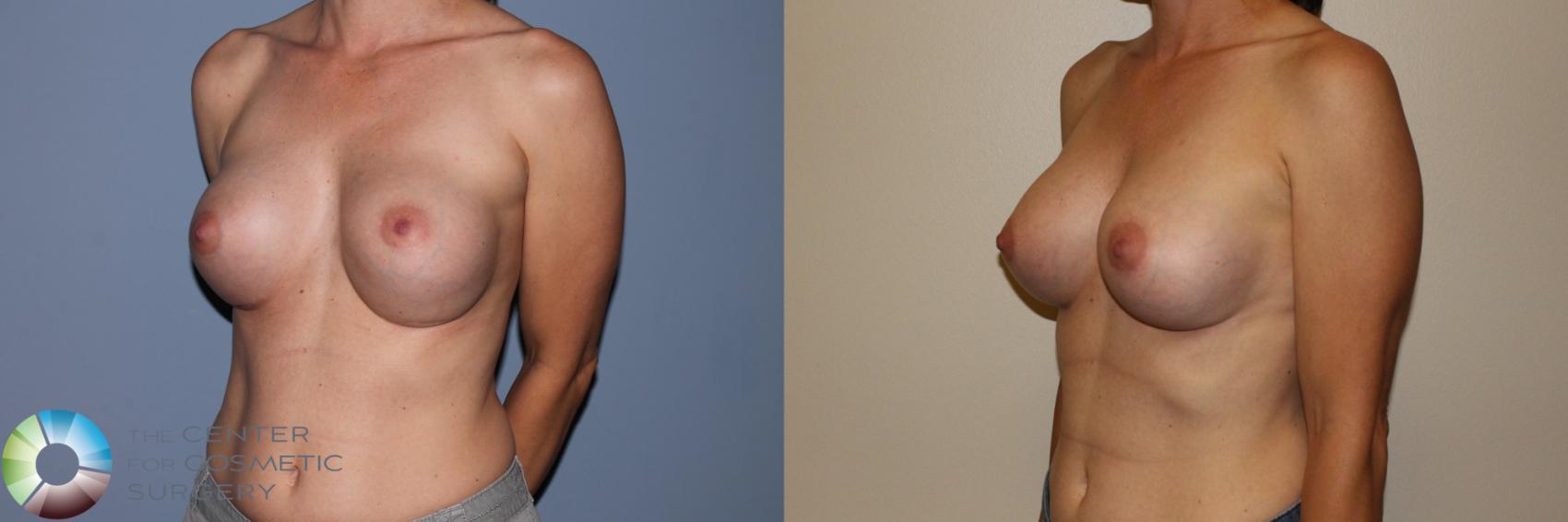 Before & After Breast Implant Revision Case 11501 Left Oblique View in Denver & Golden, CO